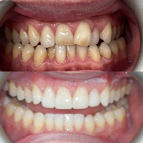 Teeth Straightening Southport