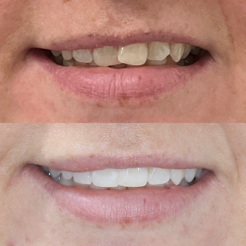 Teeth Straightening Southport