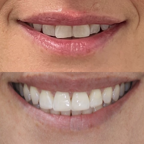 Teeth Straightening Southport