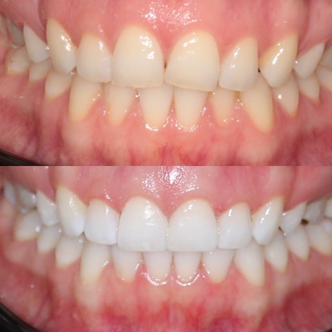 Teeth Straightening Southport