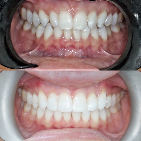 Teeth Straightening Southport
