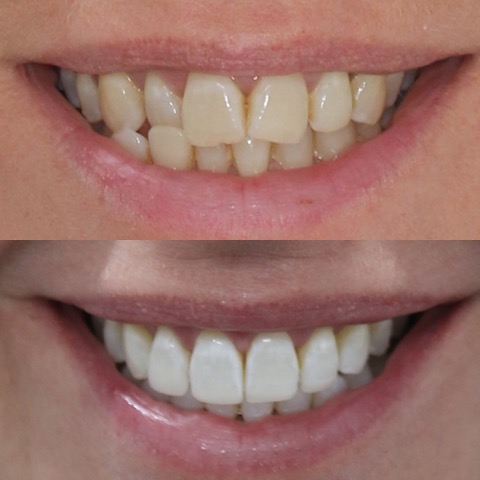 Teeth Straightening Southport