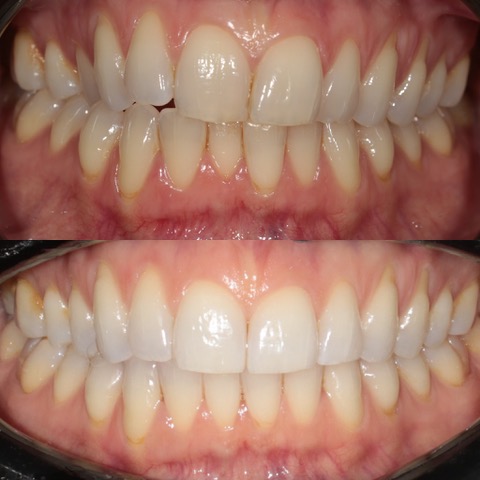Teeth Straightening Southport