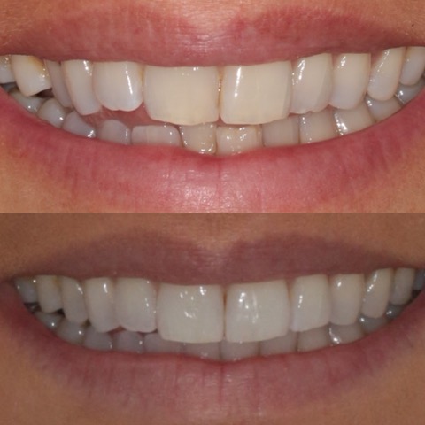Teeth Straightening Southport